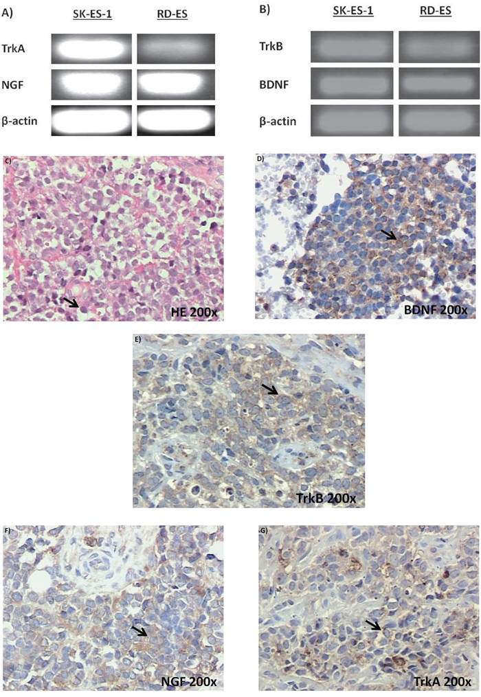 Neurotrophin and Trk mRNA expression in cell lines and protein content in tumor samples.