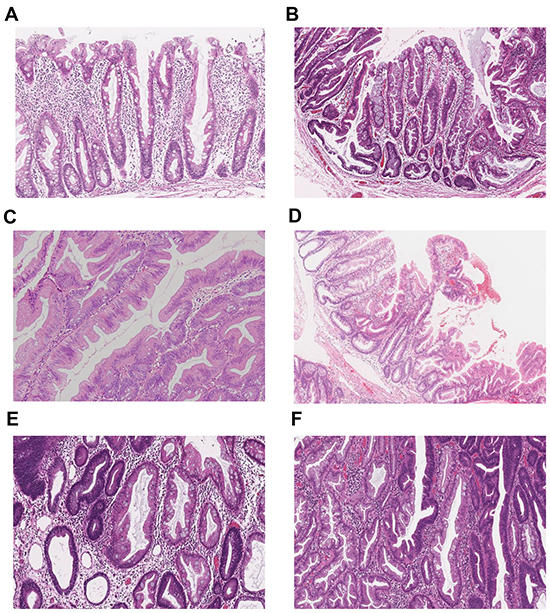 Representative histopathological images of the major serrated lesion subtypes.