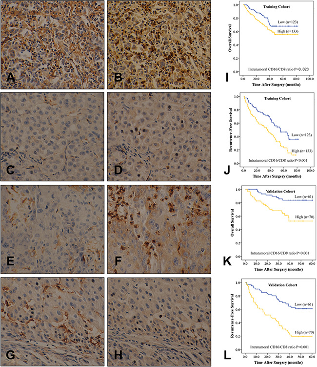 Immunohistochemical and kaplan-meier analyses of intratumoral CD16 and CD8, and the ratio of the two.
