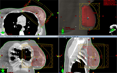 Electronic tissue compensation was employed to create a dynamic MLC fluence map.