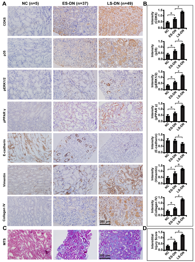 Expression levels of CDK5 and related markers in renal biopsies of DN patients and relationship with renal fibrosis.