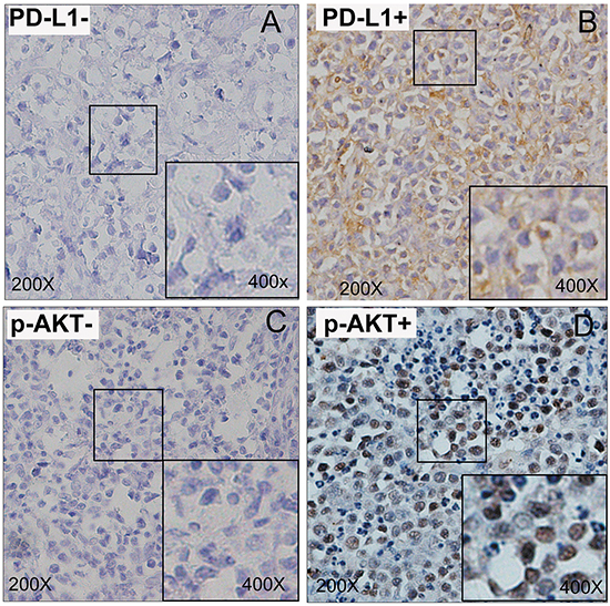 Immunohistochemical staining of DLBCL tumour tissues for PD-L1 and p-AKT expression.