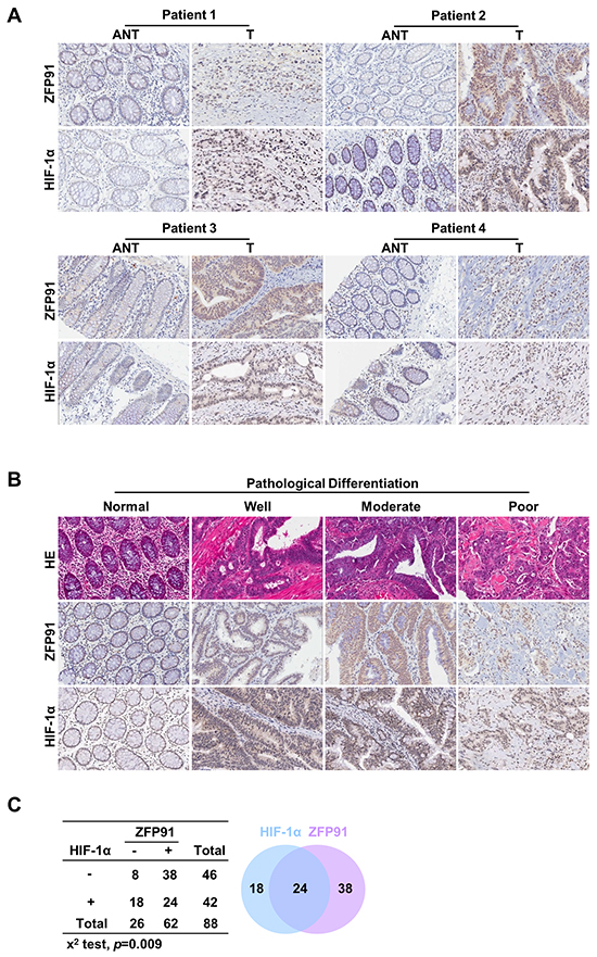 Up-regulation of ZFP91 and HIF-1&#x03B1; in colon cancer patients correlates with poor prognosis.