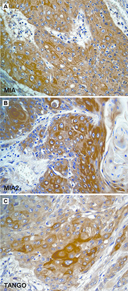 Immunostaining of the MIA gene family in esophageal cancer.