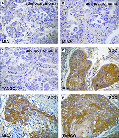 Expression of the MIA gene family in lung cancer.