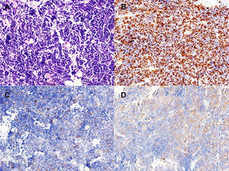 Morphology and immunohistochemistry of small cell lung carcinoma (SCLC).