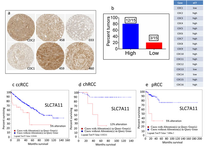 Overexpression of xCT in CDC tumors and the association of xCT (SLC7A11) overexpression with overall poor survival in ccRCC, chRCC and pRCC patients.