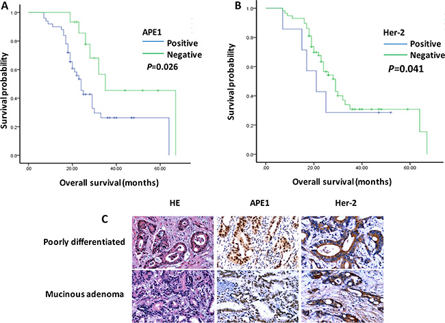 APE1 and Her-2 overexpression associated with poor prognosis of patients with gastric cancer.