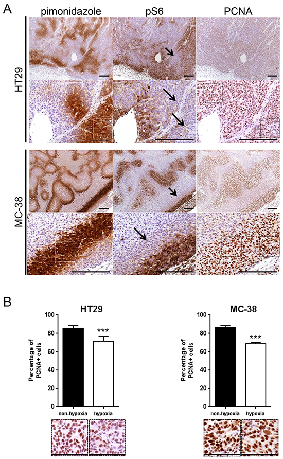 mTORC1 activity is reduced in hypoxic regions of a tumor.