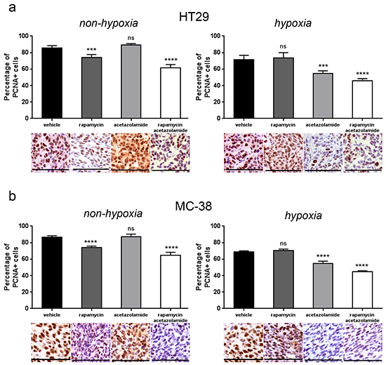 CAIX inhibition by acetazolamide has an anti-proliferative effect on hypoxic tumor regions.