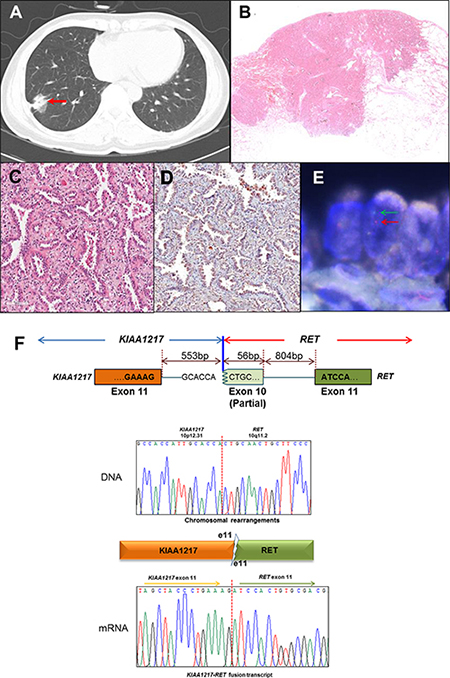 Identification of the KIAA1217-RET fusion gene, (A&#x2013;E) Clinical and pathological analysis of lung adenocarcinoma harboring RET fusion genes.