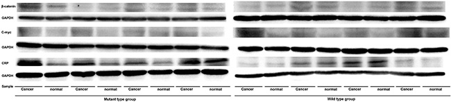 The expression levels of C reaction protein, &#x03B2;-catenin, C-myc genes of CRC patients.