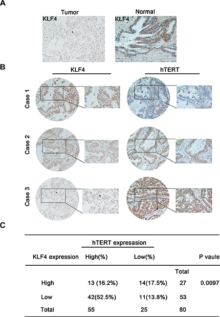 KLF4 and hTERT expression in lung tumor specimens and their correlation with patient outcomes.