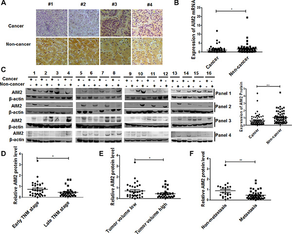 Expression of AIM2 protein and mRNA in HCC tissues and corresponding non-cancerous liver tissues.
