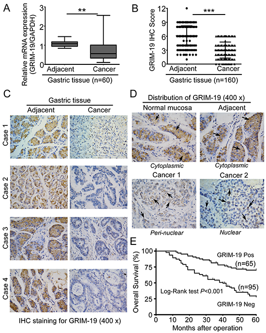 GRIM-19 is severely depressed or lost in human GC tissues.