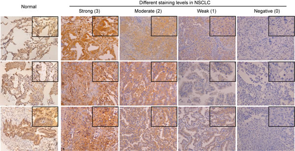 Immunohistochemical staining of HTRA3 protein in normal and lung cancer tissues.