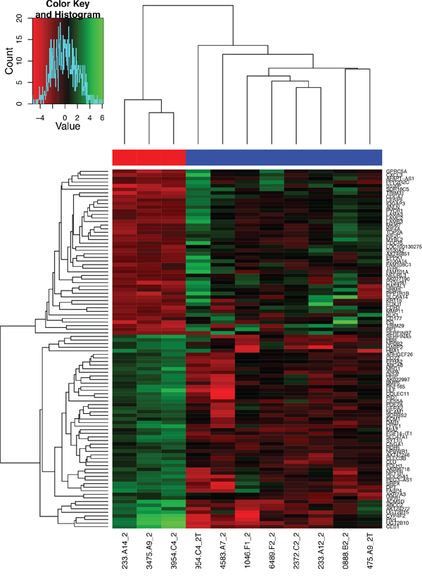 Heat map of the 100 most overexpressed (red) and underexpressed (green) genes in the formalin-fixed, paraffin-embedded GBC specimens.