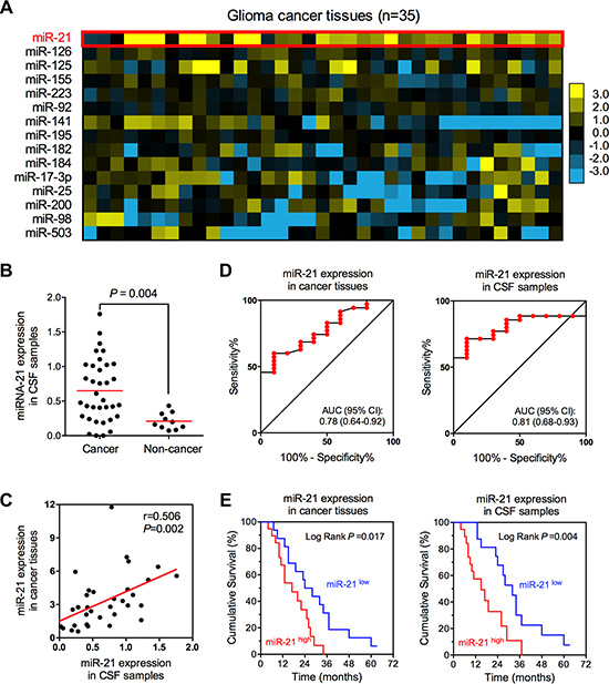 The expression of miR-21 in glioma tissue and CSF samples.