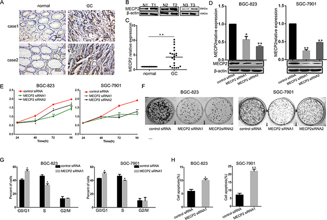 MECP2 is overexpressed in GC samples and effects cell growth and proliferation on GC cell lines in vitro.