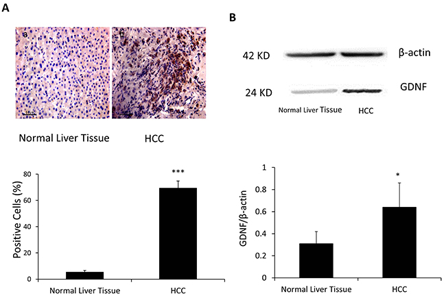 GDNF was overexpressed in the HCC as compared to the normal liver tissue.
