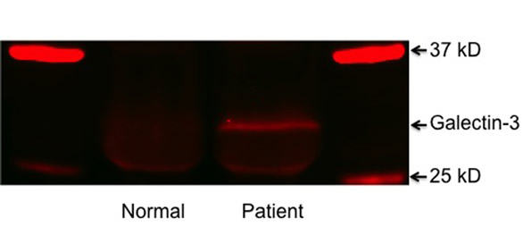 Detection of galectin-3 in sera of form normal male and PCa patient.