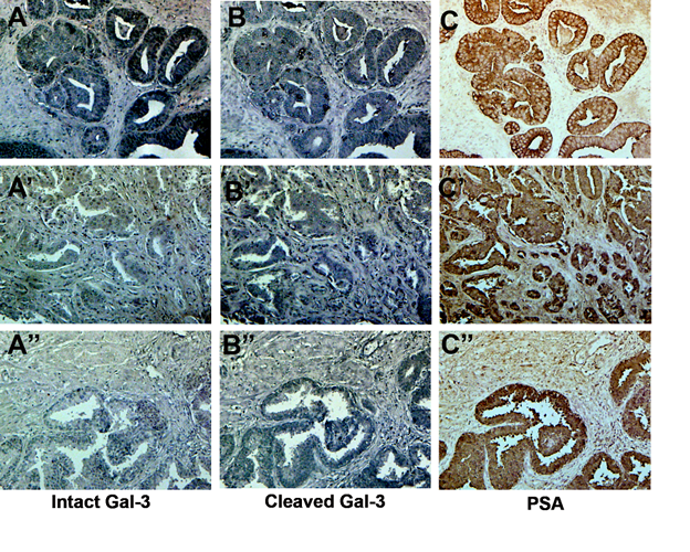 Cleavage of galectin-3 in PCa and normal tissues.