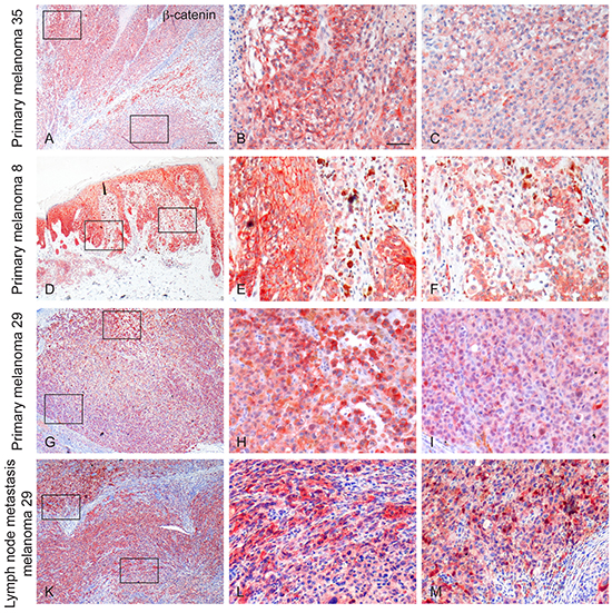 Immunohistochemical expression of &#x03B2;-catenin in primary and metastatic melanomas.
