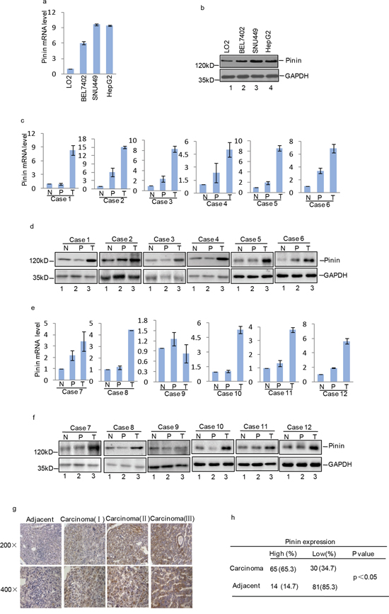 Expression of Pinin in normal human liver tissues, HCC tissues, normal human liver cell line and HCC cell lines.