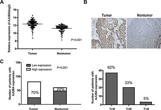 AJUBA was frequently upregulated in ESCC tissues compared with non-tumor tissues.