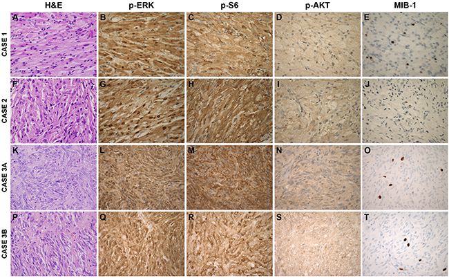 MAPK and PI3K Pathway Signaling in Spindle Cell Oncocytoma Cases.