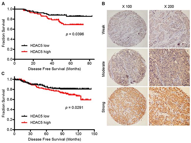 High HDAC5 mRNA and protein expression predict a worse prognosis for patients with BC.