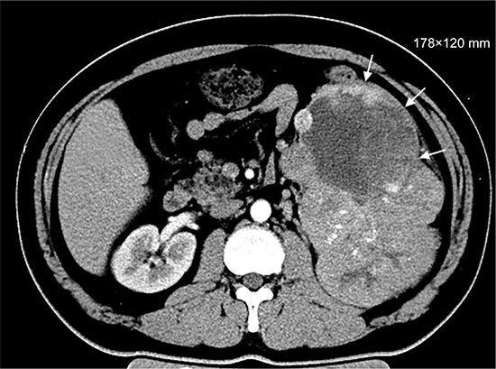 Renal CT (Without any treatment, November 2013).