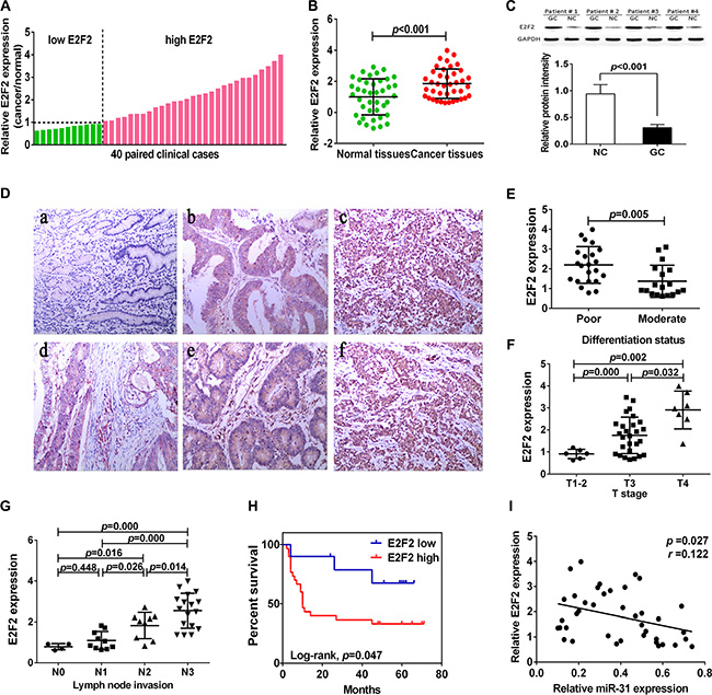 Upregulation of E2F2 expression in gastric cancer tissues.