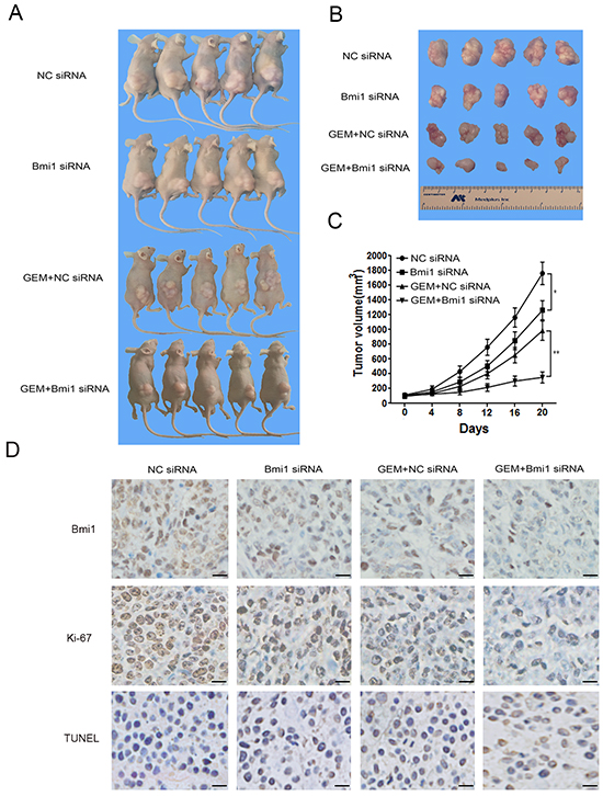 Bmi1 inhibition sensitizes the effect of gemcitabine in pancreatic xenograft tumors.