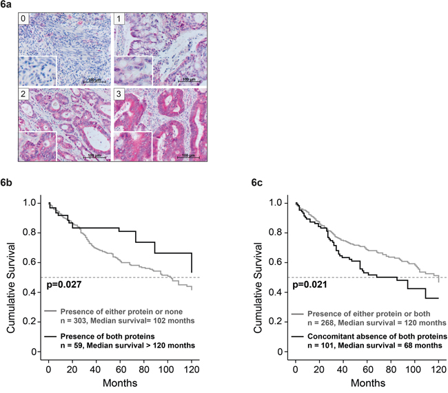 Correlation of combined STAT1 and IL-6R&#x03B1; expression in CRC tissue with patient survival.