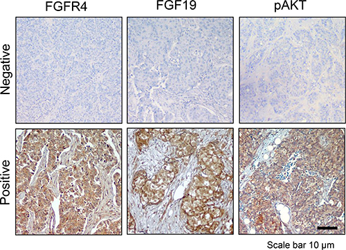 FGFR4/FGF19 co-expression is associated with AKT phosphorylation in a subset of breast cancer cells.