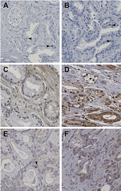Immunohistochemical expression of HELLS (A, B), ZIC2 (C, D) and ZIC5 (E, F) in prostate cancer.