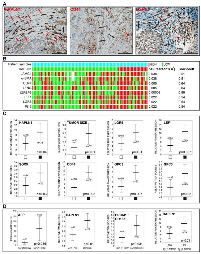 HAPLN1 is detected in HCCs featuring stem cell markers, high alpha-fetoprotein levels, vascular invasion and &#x3b2;-catenin activation.