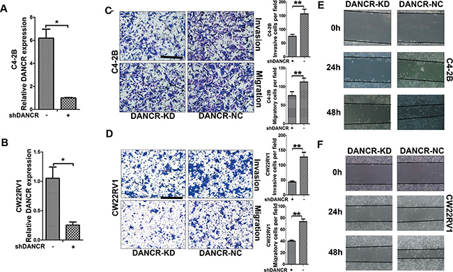 Knockdown of DANCR decreases migration and invasion of prostate cancer cells.