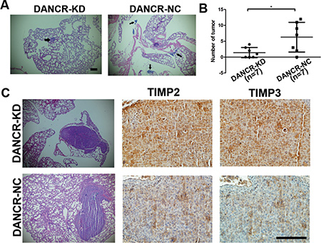 Knockdown of DANCR decreases migration and invasion of prostate cancer cells in vivo.