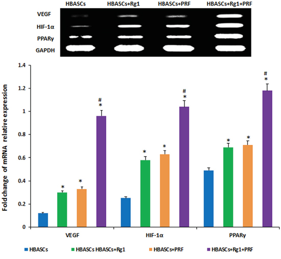 mRNA expression of PPAR&#x03B3;, HIF-1&#x03B1;, and VEGF were much higher in neogenetic adipose tissue of group D than in the other three groups, and had a reasonably higher expression in the single treated groups.