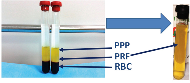 Isolation of PRF clots from venous whole blood after centrifugation: