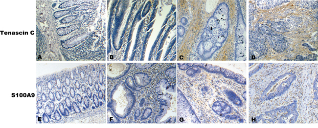 A representative result of immunohistochemistry shows the expression of TNC, S100A9 in stroma at NCM, ACP, CIS and ICC.