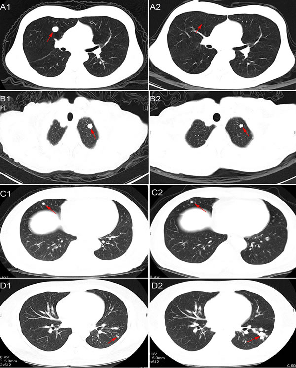 Representative images of chest CT scans showing response to radiotherapy.