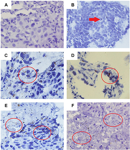 Distribution and heterogeneity of PD-L1 mRNA signals.