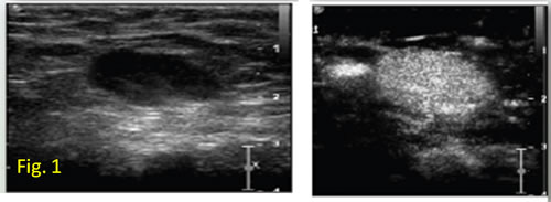 Reactive lymph node: CEUS shows an intense, centripetal, rapid and uniform enhancement in the arterial phase.