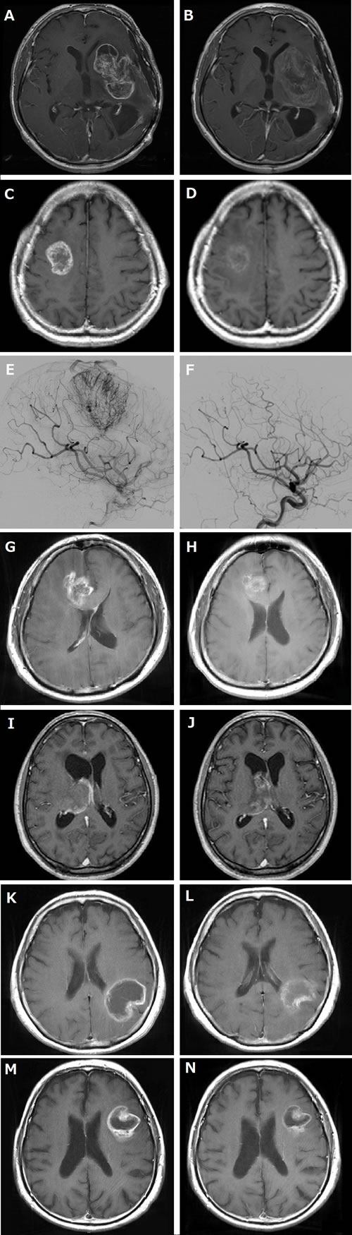 MRI and angiography of before and after neoadjuvant bevacizumab (Bev).