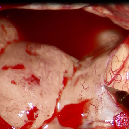 Intraoperative photograph during tumor removal in case 1 under neoadjuvant bevacizumab.