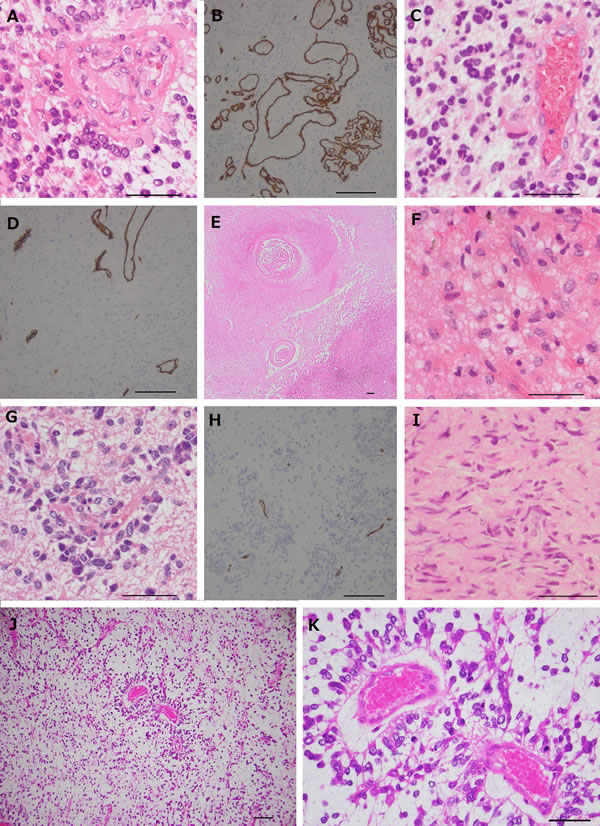 Photomicrographs of the tumors resected under neoadjuvant bevacizumab (Bev).