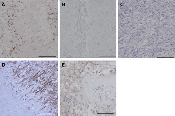 Immunohistochemical analysis for HIF-1&#x3b1; and CA9 in the tumors resected under neoadjuvant bevacizumab (Bev) as compared with that in control glioblastomas.